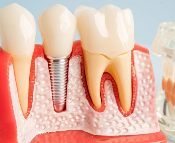 What Are Dental Implants?