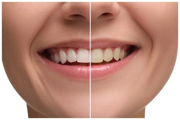 What Is Teeth Whitening