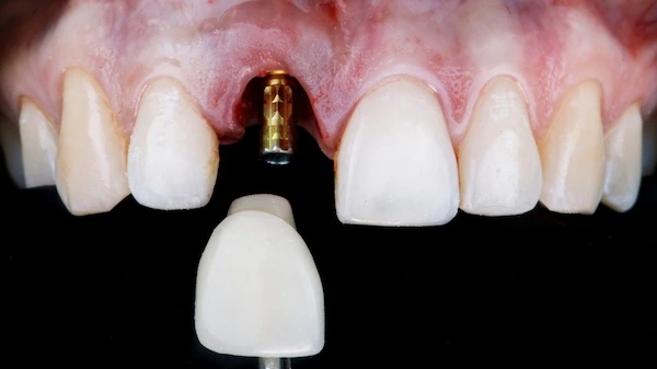 Why dental implants important